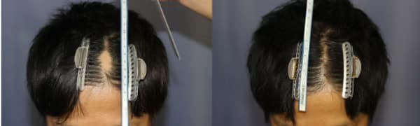 疤痕植髮個案一 (300株) - 術前