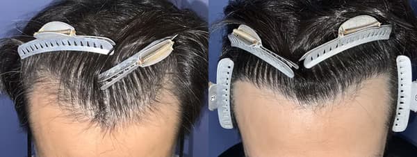 髮際線植髮個案二 (1000株) - 術前