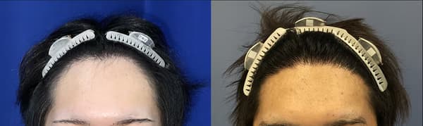 髮際線植髮個案三 (2000株) - 術前