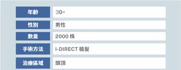 頭頂植髮個案一 (2000株) - 術後