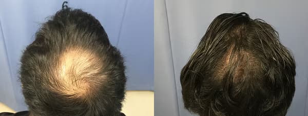 2000株植髮個案三 - 術前