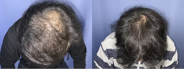 整體植髮個案二 (3000株) - 術前