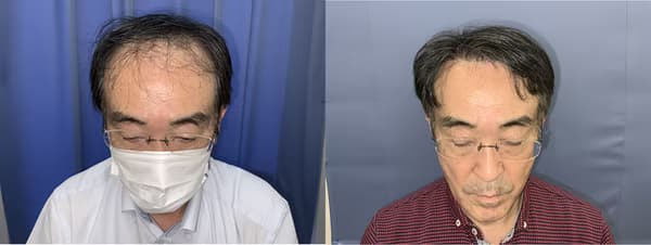 前額植髮個案一 (1200株) - 術前