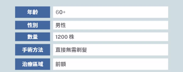 前額植髮個案一 (1200株) - 術後