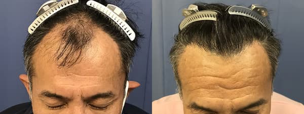 前額植髮個案二 (1800株) - 術前