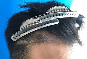 真實用家-植髮94天後效果