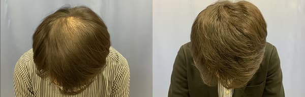 髮際線植髮個案 - 效果對比