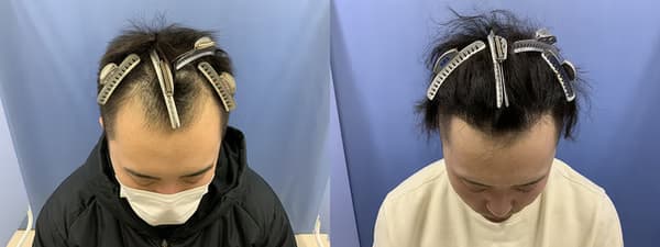 M 字額植髮案例術前術後對比
