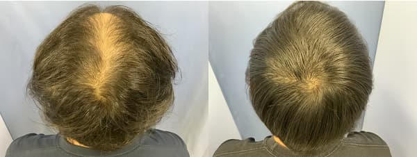 頭頂植髮個案三 (4100株) - 術前