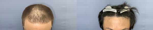 整體植髮個案 - 效果對比