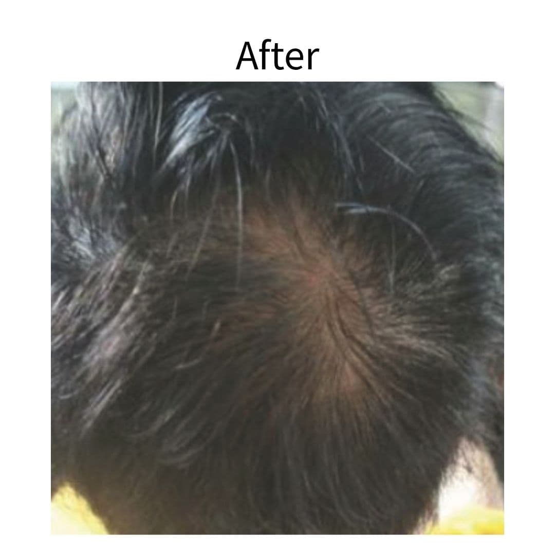 EXOSOME 外泌體育髮療程 — 案例一 治療後