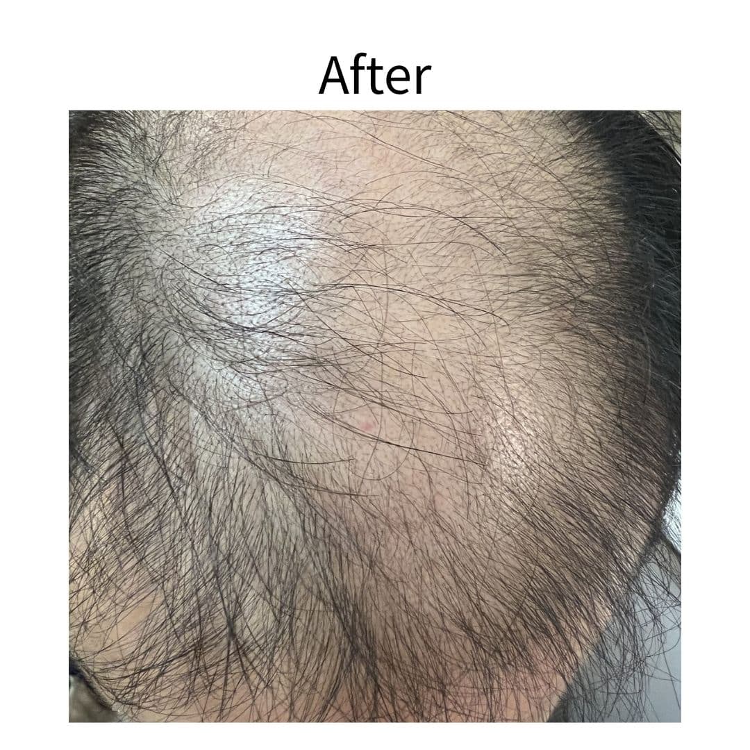 EXOSOME 外泌體育髮療程 — 案例二 治療後