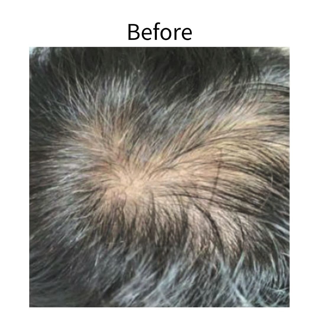 EXOSOME 外泌體育髮療程 — 案例一 治療前