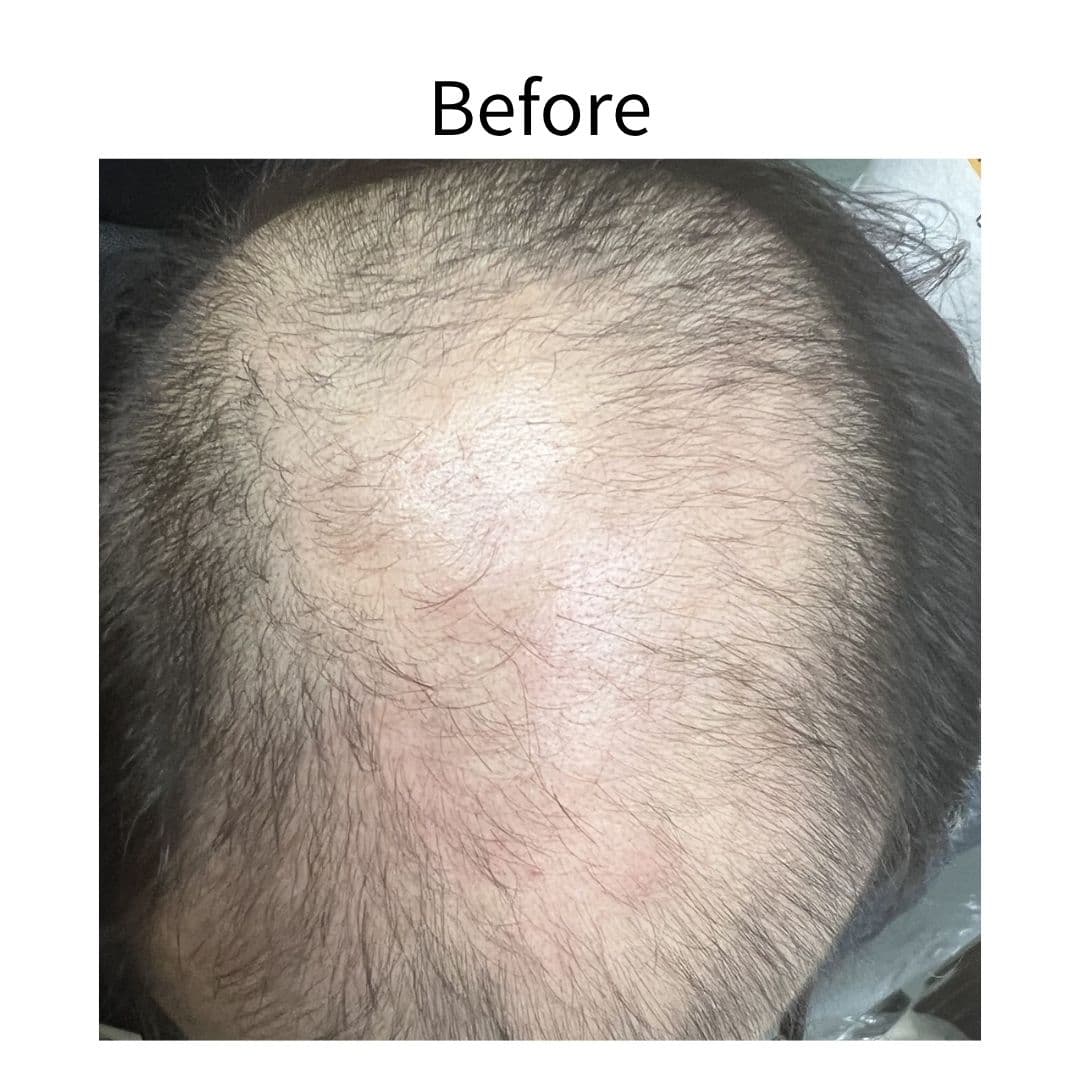 EXOSOME 外泌體育髮療程 — 案例二 治療前