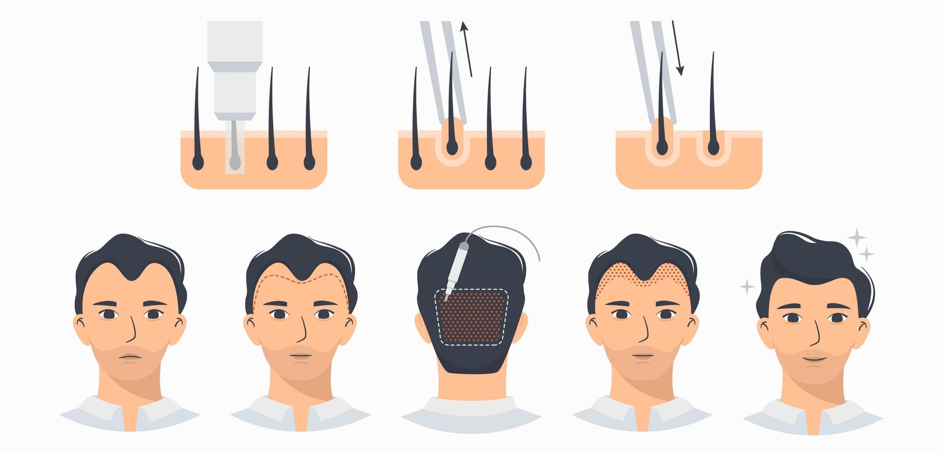植髮過程示意圖 — 從脫髮到恢復濃密頭髮