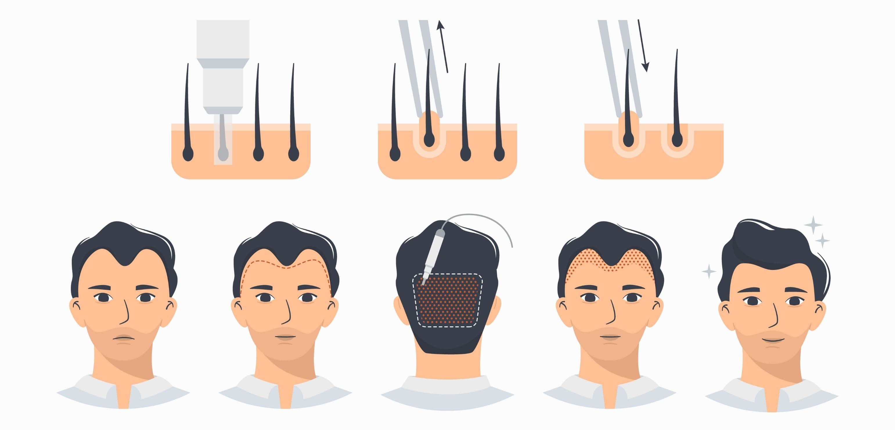 I-Direct 植髮技術與 95% 毛囊存活率