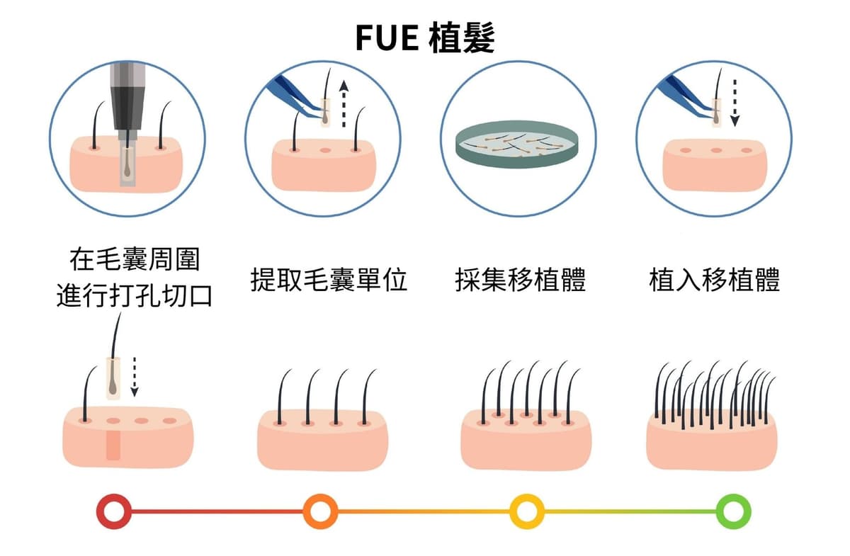 FUE 植髮技術步驟示意圖