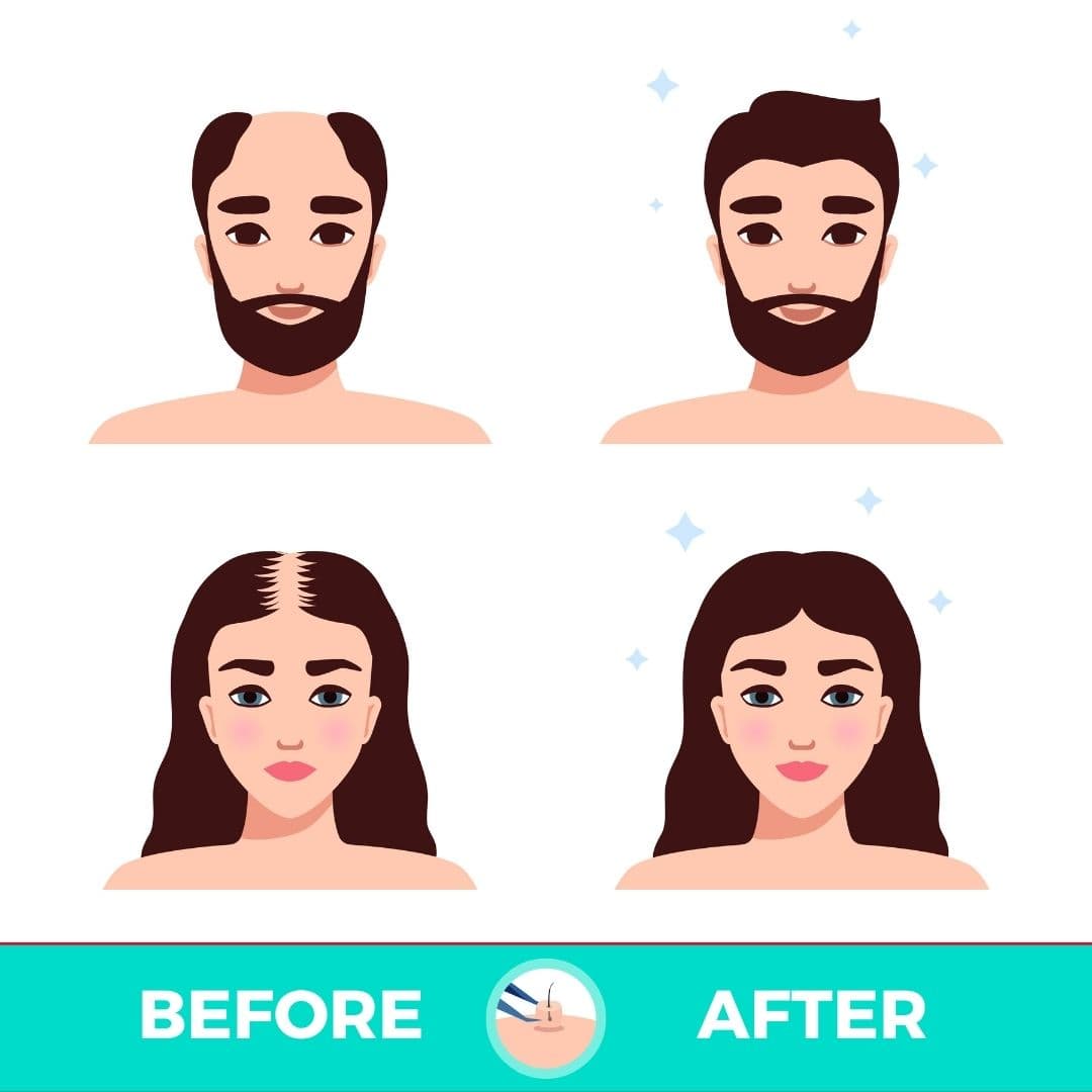 植髮前後對比 — 男女效果展示