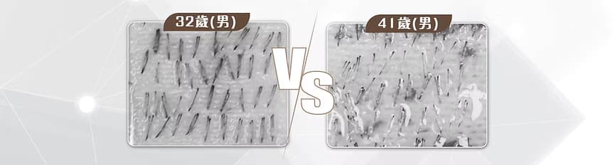 不同年齡的毛囊健康狀況對比