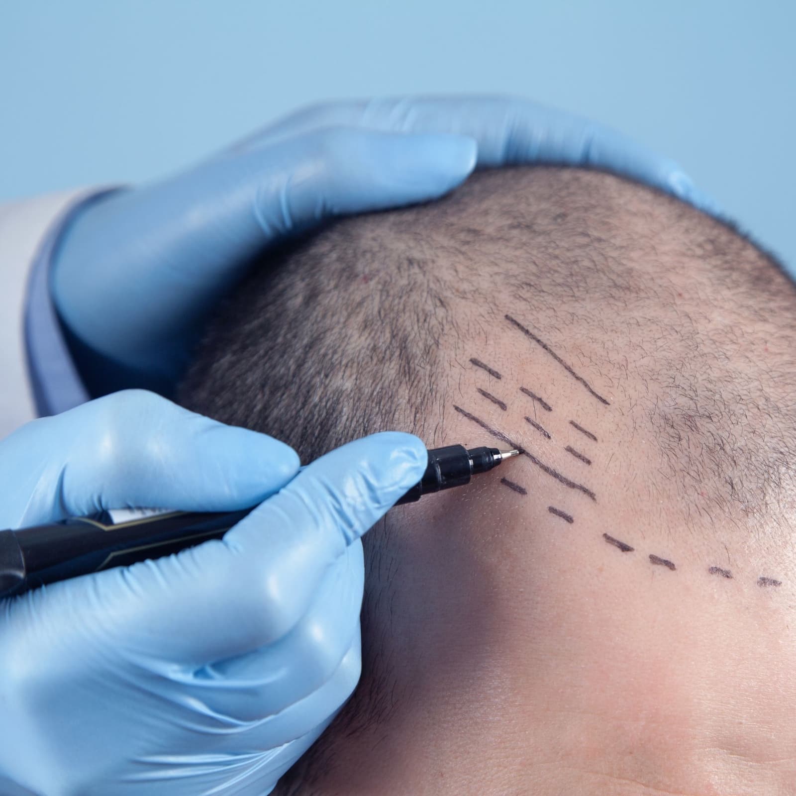 i-Direct 無痕植髮