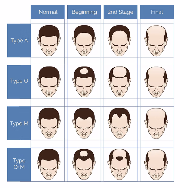 常見脫髮種類圖片