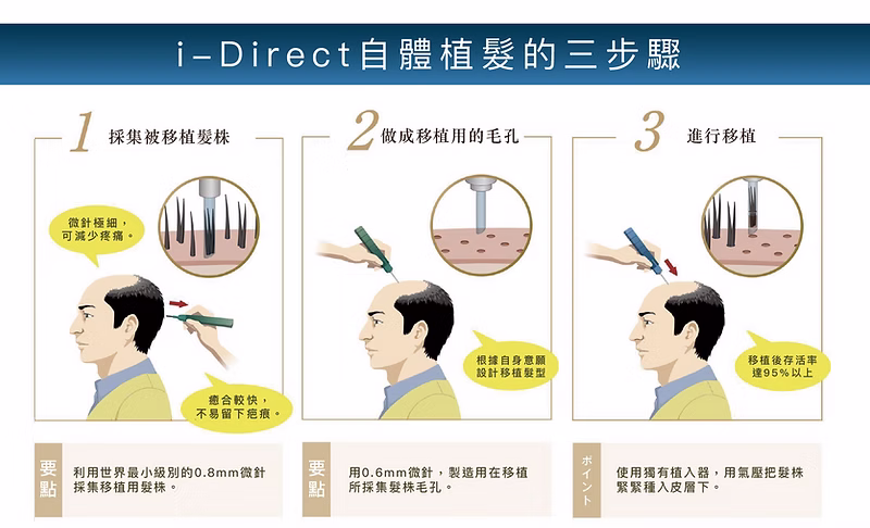 i-Direct 自體植髮步驟一和二